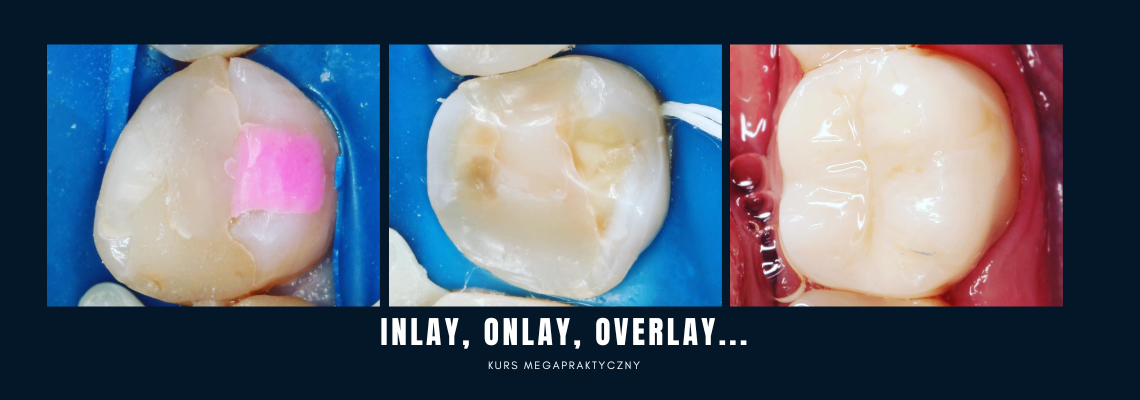 Adhezyjne uzupełnienia zębów w odcinku bocznym - inlay, onlay, overlay.